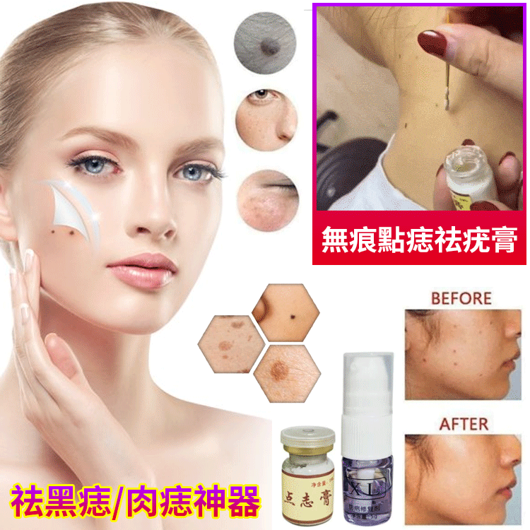 【點痣套裝】點痣膏+修復液 無痕去痣痦子去瘊子扁平尤絲狀尤尖尤肉刺肉粒 【點痣套裝】點痣膏+修復液 無痕去痣痦子去瘊子扁平尤絲狀尤尖尤肉刺肉粒